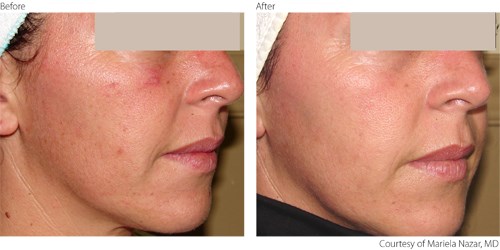 Before and after IPL treatments