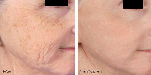 Before and after MicroNeedling