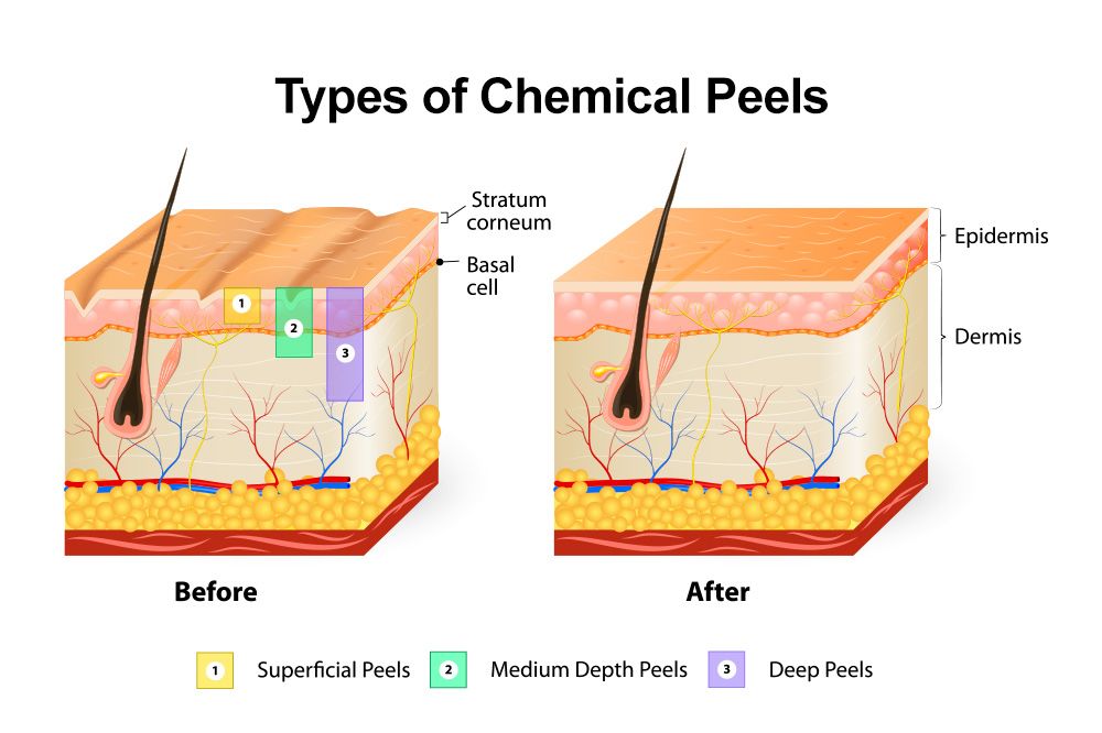 Types of Chemical Peels