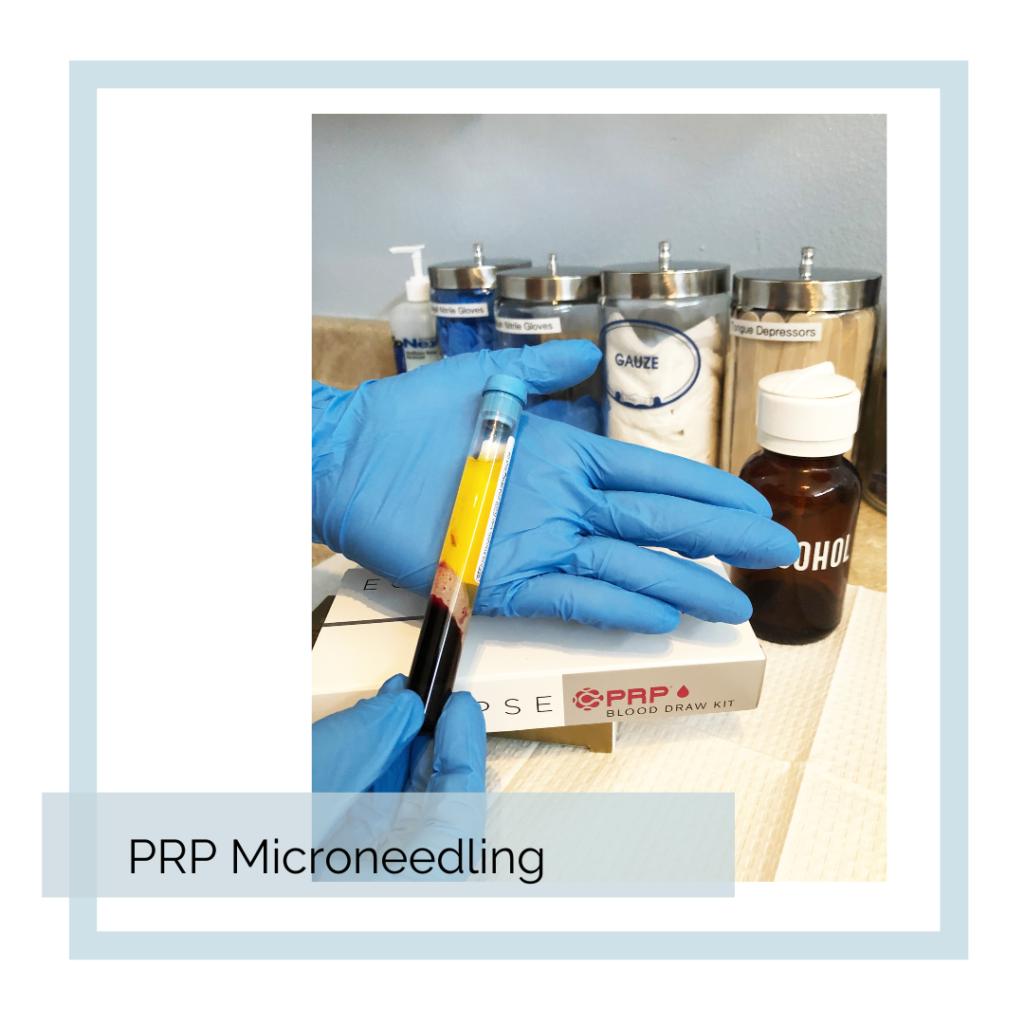 Abbracci Medical Spa PRP Microneedling