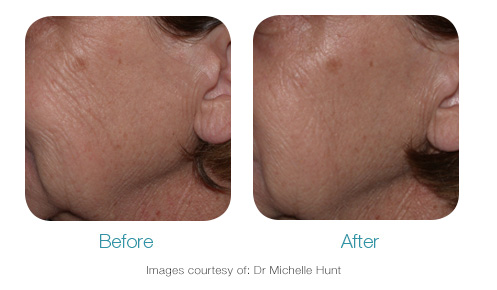 Before and after results