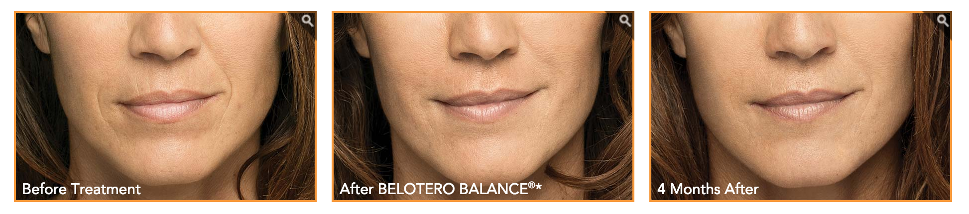 Belotero before and after results