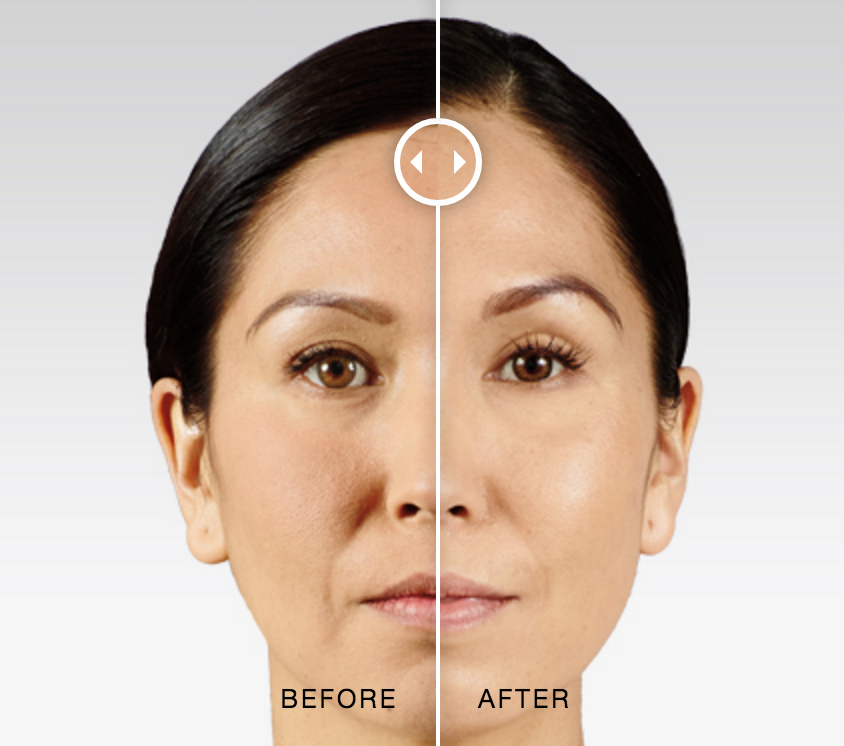 Before and after Juvederm Voluma photos