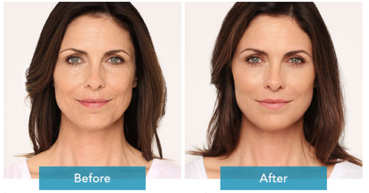Radiesse Filler for Wrinkles South Bay, CA Abbracci Med Spa