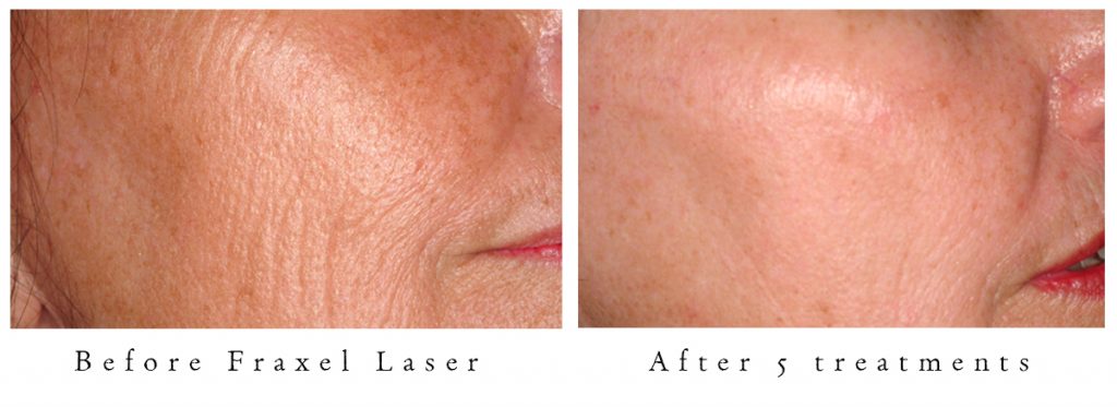 Fraxel Laser Results