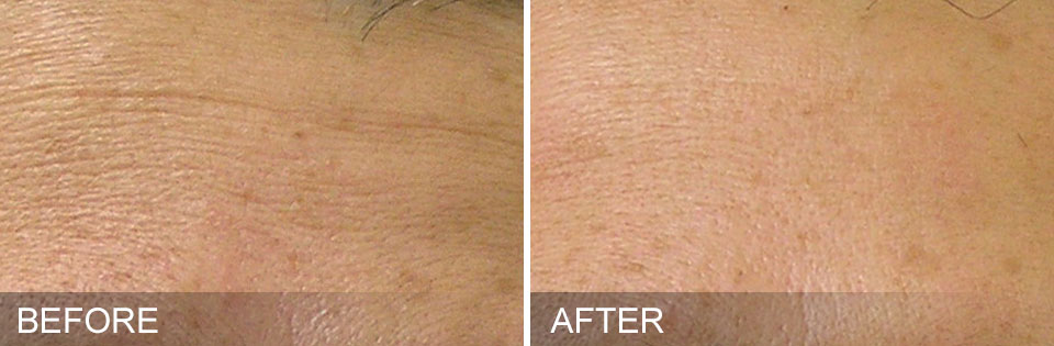 Hydrafacial before and after - 1