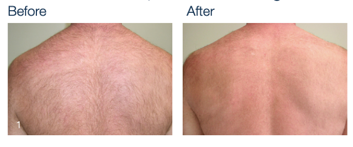 Laser Hair Removal for Men at Abbracci Med Spa