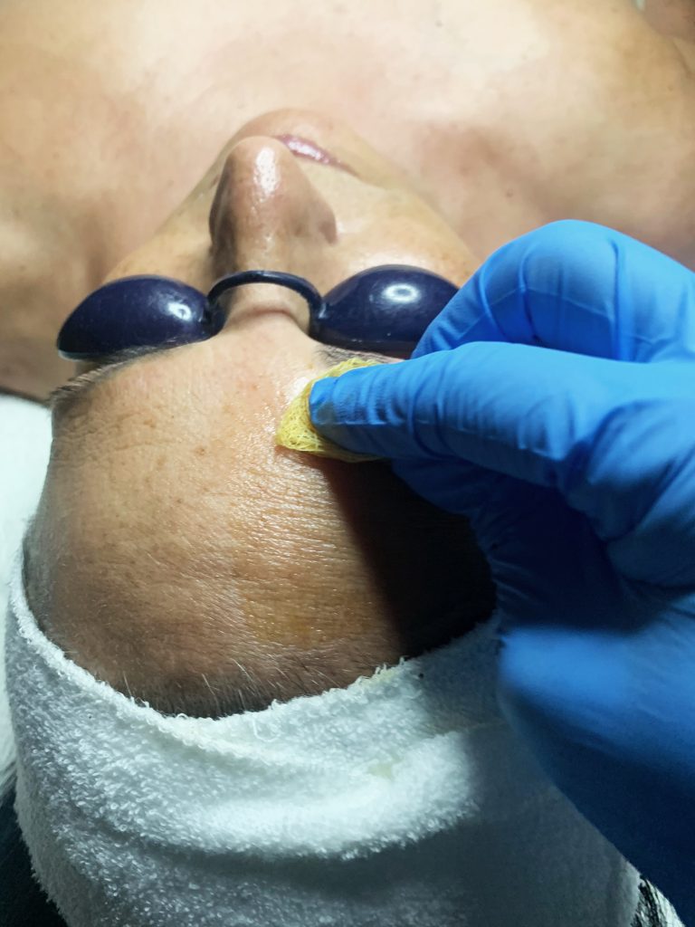 The Perfect Derma Peel