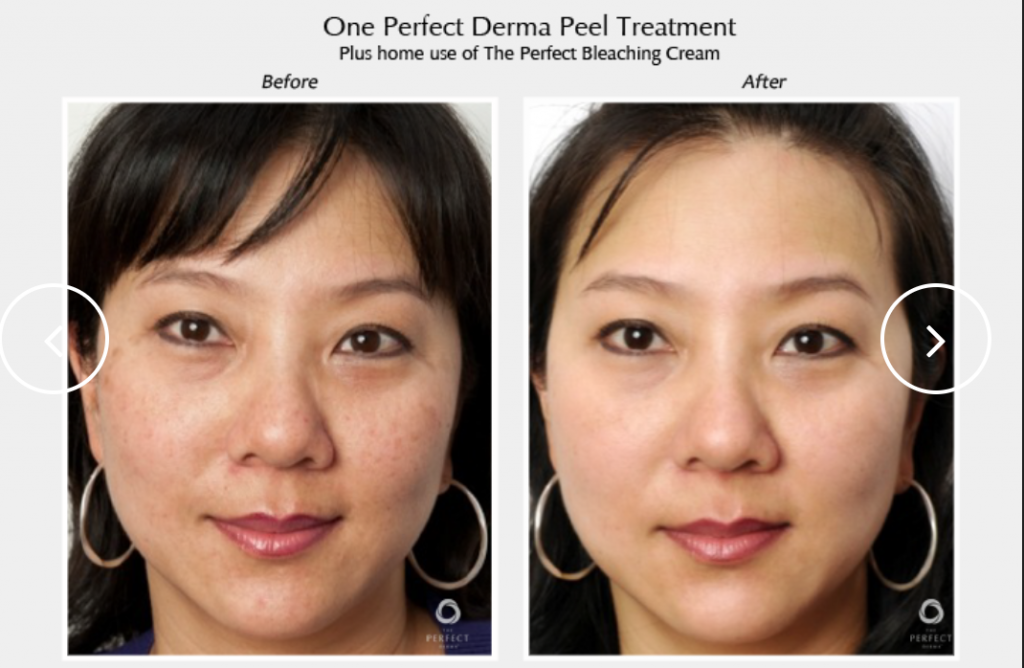 Perfect Derma Peel Before and After