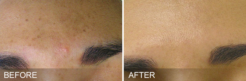 HydraFacial Brown Spots