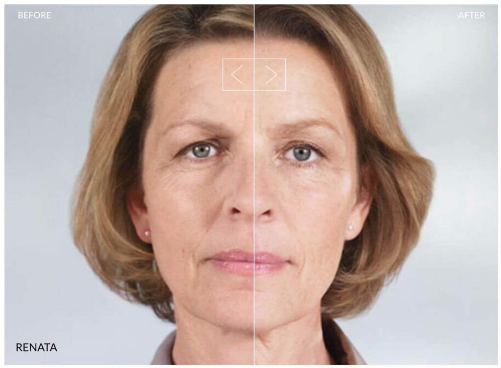 Sculptra before and after