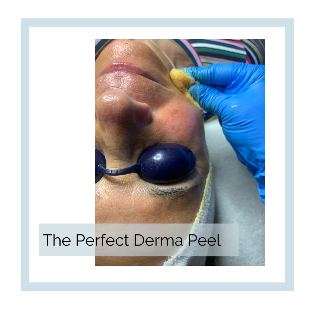 Perfect Derma Peel Abbracci Med Spa
