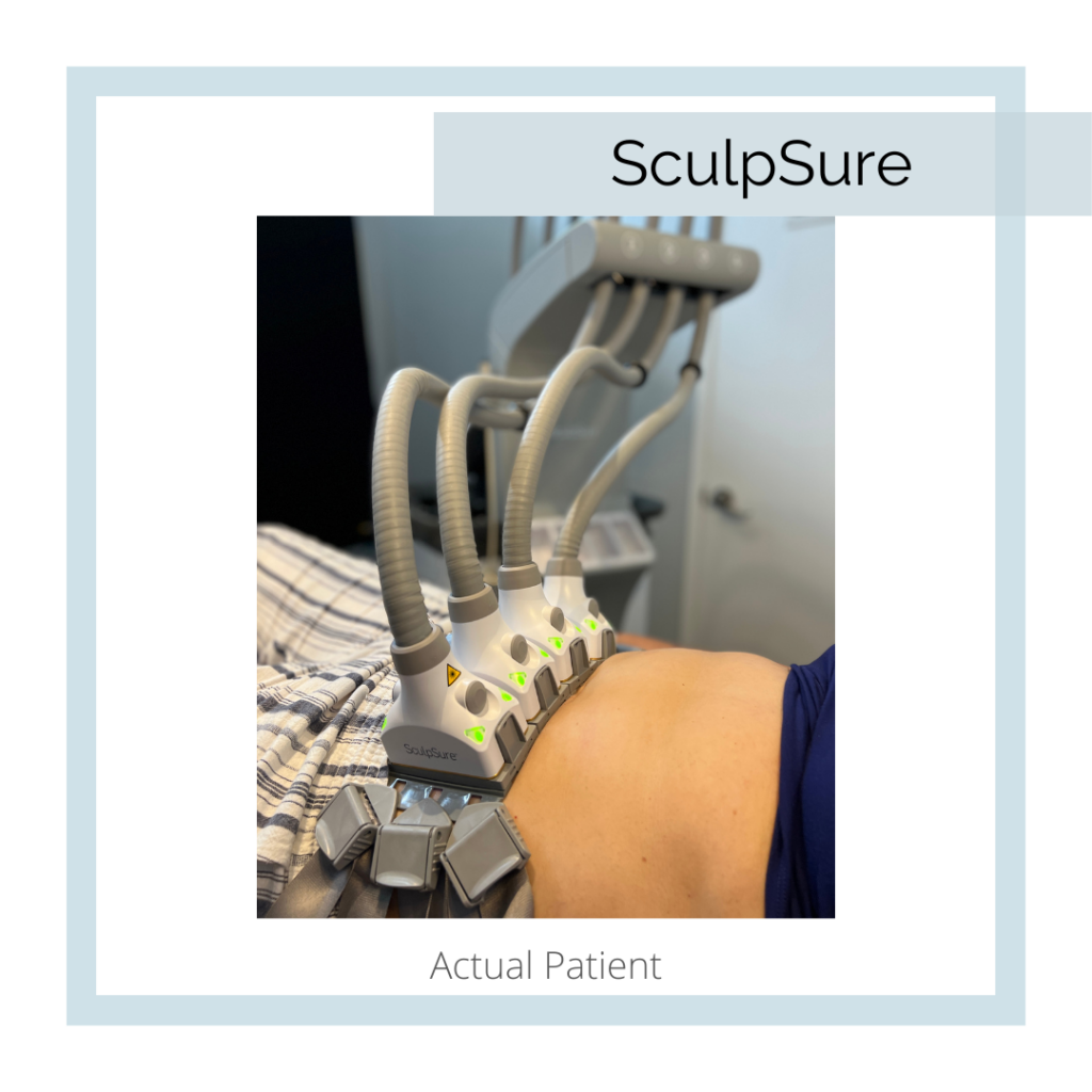 Abbracci Medical Spa SculpSure