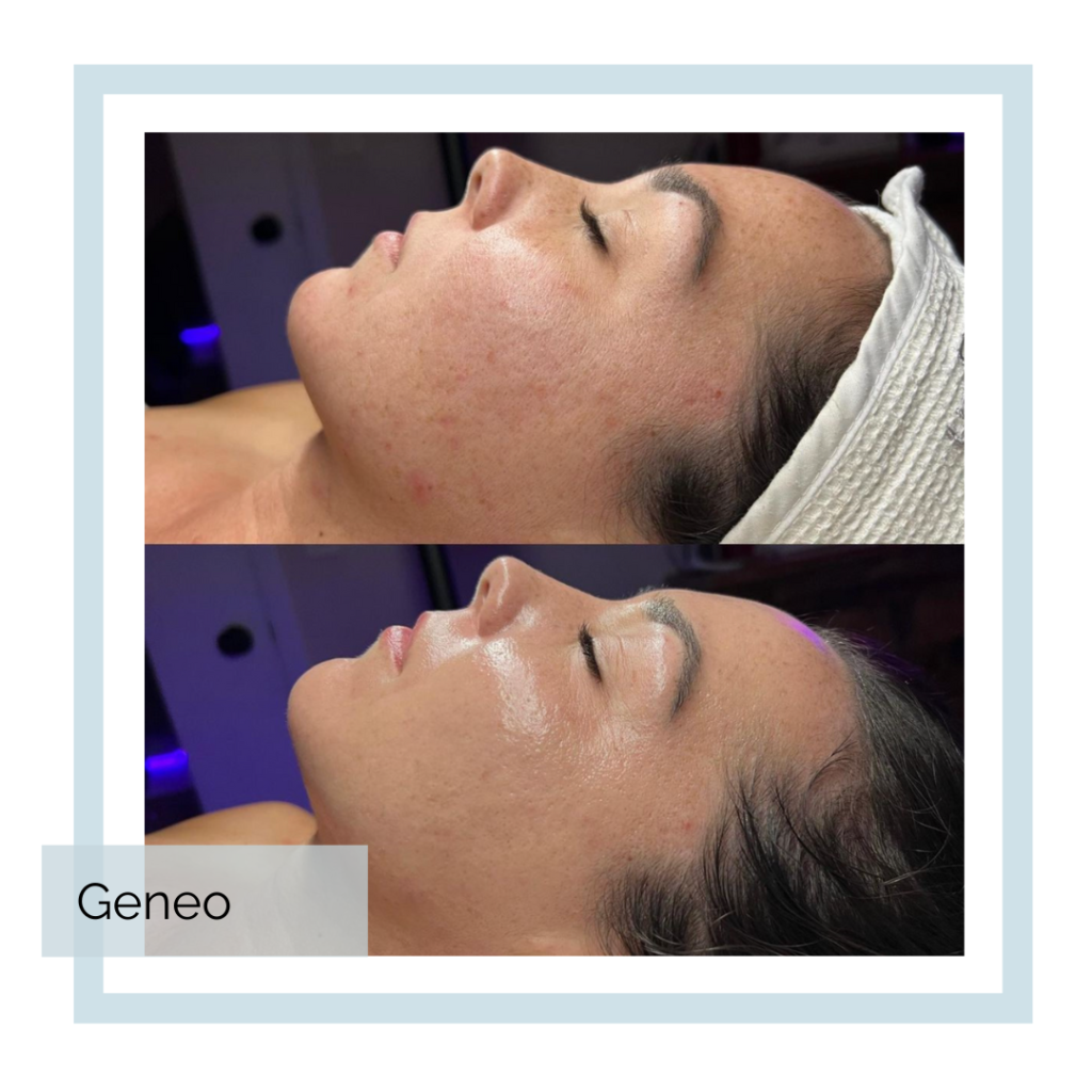 Geneo Treatment at Abbracci Medical Spa