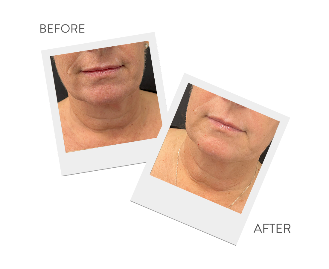 Before and after images of Solaria Laser results